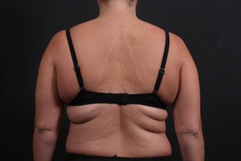This 39 year old female underwent the Bra Line Back Lift procedure before 752180