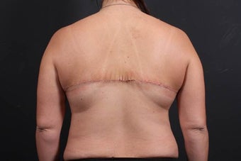 This 39 year old female underwent the Bra Line Back Lift procedure 752180
