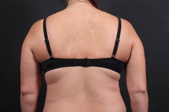 This 39 year old female underwent the Bra Line Back Lift procedure after 752180