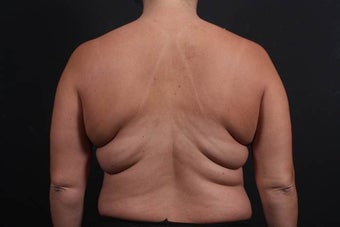 This 39 year old female underwent the Bra Line Back Lift procedure 752180