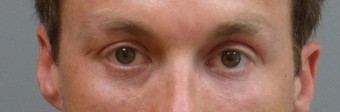 35-44 year old man treated with Restylane after 2195807