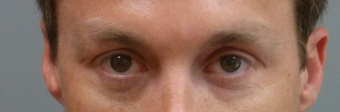 35-44 year old man treated with Restylane before 2195807