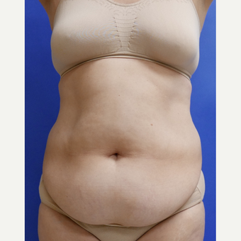 55-64 year old woman treated with Tummy Tuck before 3165543