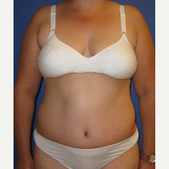 55-64 year old woman treated with Tummy Tuck after 3165543