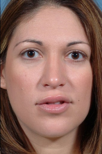 Rhinoplasty after 81109