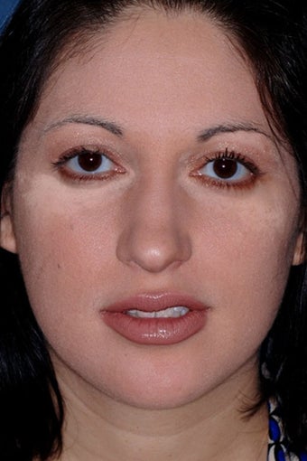 Rhinoplasty before 81109