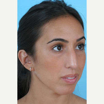 25-34 year old woman treated with Rhinoplasty before 3691133