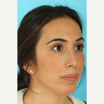 25-34 year old woman treated with Rhinoplasty after 3691133