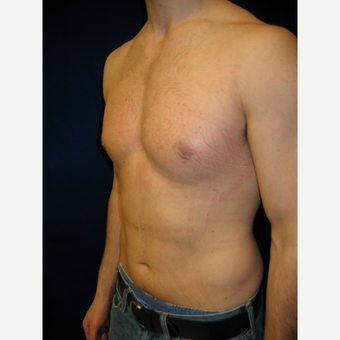 35-44 year old man treated with Male Breast Reduction after 3727278