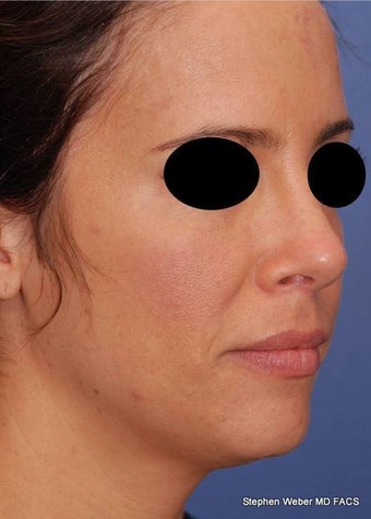 25-34 year old woman treated with Rhinoplasty after 3624188