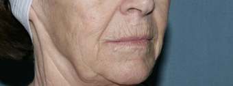 Face and Neck Fraxel repair with C02/Erbium lasers for upper lip wrinkles before 104646