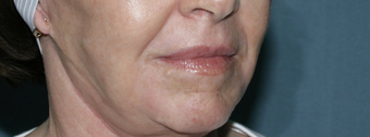 Face and Neck Fraxel repair with C02/Erbium lasers for upper lip wrinkles after 104646