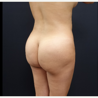 25-34 year old woman treated with Butt Augmentation before 3286186