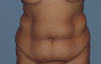 Abdominoplasty (tummy tuck) in the fuller patient before 845751