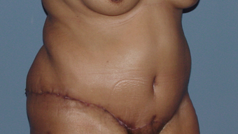 Abdominoplasty (tummy tuck) in the fuller patient 845751
