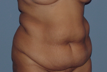 Abdominoplasty (tummy tuck) in the fuller patient 845751