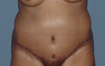 Abdominoplasty (tummy tuck) in the fuller patient after 845751
