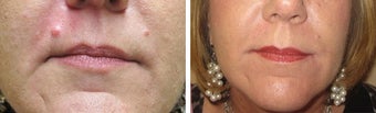 Mole Removal photos before 951875