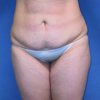25-34 year old woman treated with Tummy Tuck before 3496764