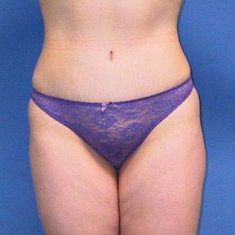 25-34 year old woman treated with Tummy Tuck after 3496764