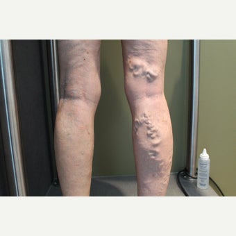 65-74 year old woman treated with Sclerotherapy before 2081414