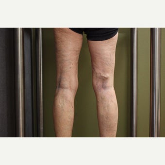 65-74 year old woman treated with Sclerotherapy after 2081414