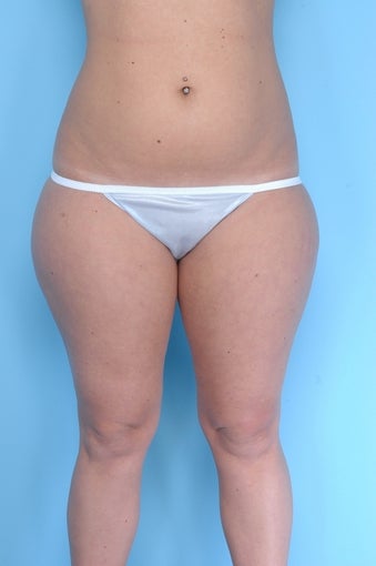 Liposuction on thighs, buttocks, abdomen before 67284
