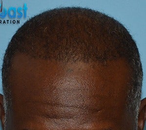 45-54 year old man treated with FUE Hair Transplant after 3624230