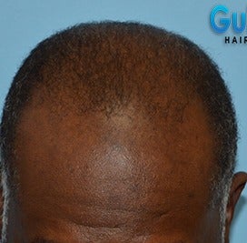 45-54 year old man treated with FUE Hair Transplant before 3624230