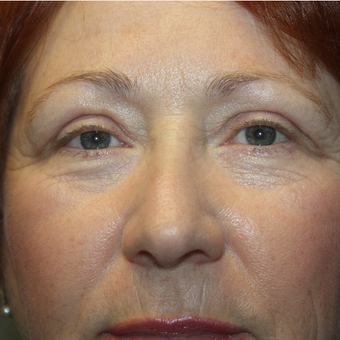 55-64 year old woman treated with Eyelid Surgery after 3808810