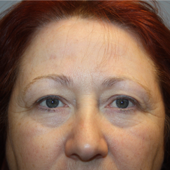 55-64 year old woman treated with Eyelid Surgery before 3808810