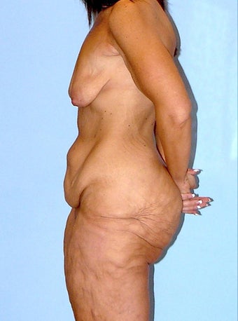 41 year old woman treated with Body Lift 1745331