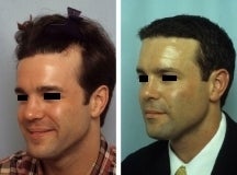 Hair replacement with Fleming/Mayer flap before 143610