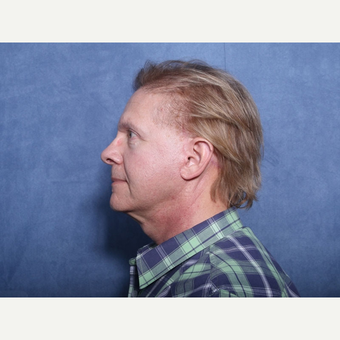 55-64 year old man treated with Neck Lift (view 2 of 2) after 3175850