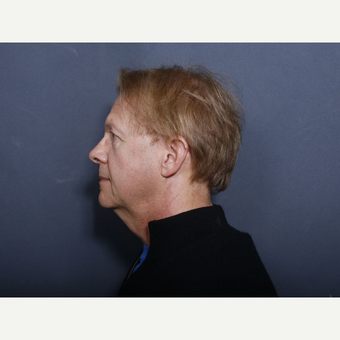 55-64 year old man treated with Neck Lift (view 2 of 2) before 3175850