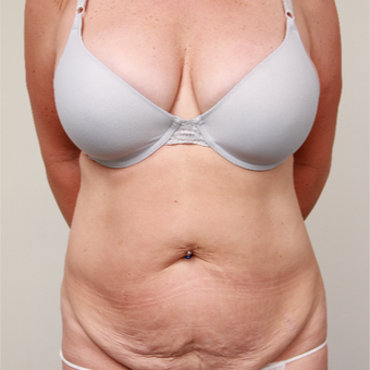 45-54 year old woman treated with Tummy Tuck before 3488411