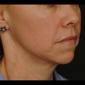 45-54 year old woman treated for Liquid Facelift before 1479641