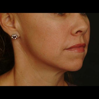 45-54 year old woman treated for Liquid Facelift after 1479641