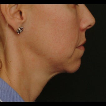 45-54 year old woman treated for Liquid Facelift 1479641