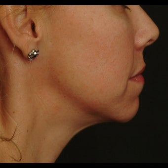 45-54 year old woman treated for Liquid Facelift 1479641