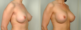 Capsulectomy with Exchange to Larger after 1515100