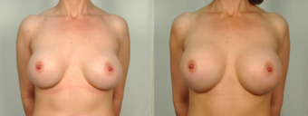 Capsulectomy with Exchange to Larger before 1515100