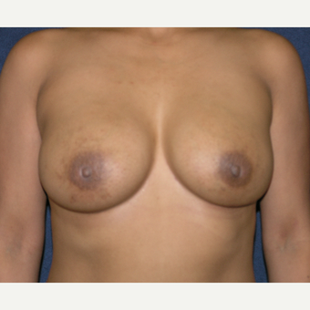 25-34 year old woman treated with Breast Implants after 3455123