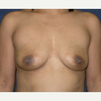 25-34 year old woman treated with Breast Implants before 3455123