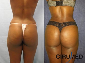 Brazilian Butt Lift transfer buttock augmentation 850cc each side. before 1331620