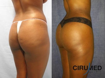 Brazilian Butt Lift transfer buttock augmentation 850cc each side. 1331620