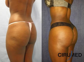 Brazilian Butt Lift transfer buttock augmentation 850cc each side. 1331620