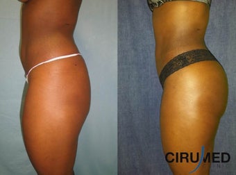 Brazilian Butt Lift transfer buttock augmentation 850cc each side. after 1331620