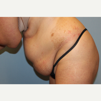 35-44 year old woman treated with Tummy Tuck before 3529120