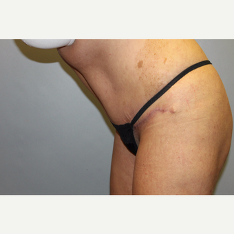 35-44 year old woman treated with Tummy Tuck after 3529120